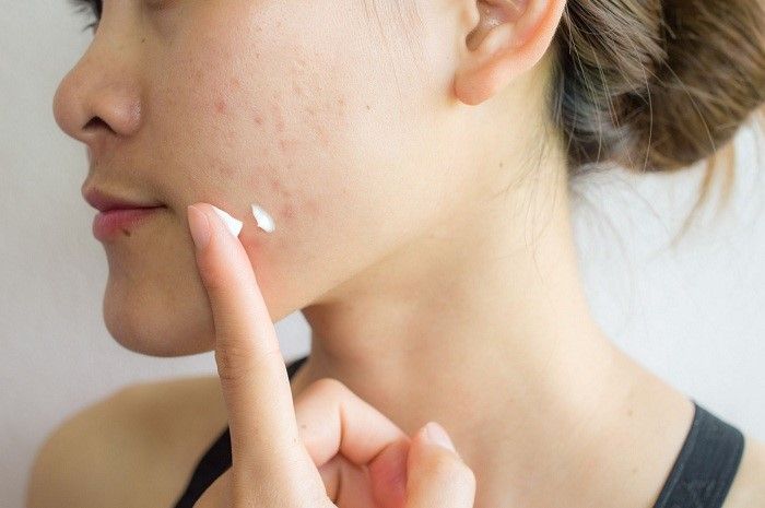 12 Loại kem trị mụn hiệu quả nhất hiện nay 12 Loại kem trị mụn hiệu quả nhất hiện nay