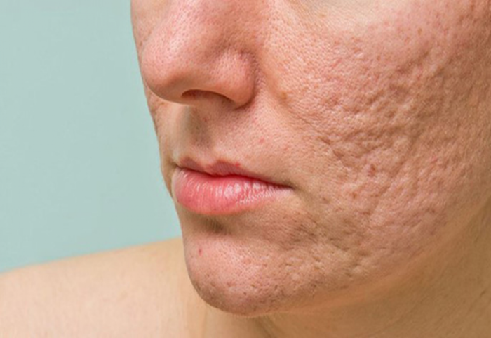 Cách điều trị sẹo rỗ để lấy lại vẻ mịn màng cho làn da